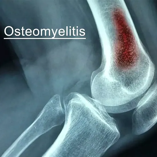 osteomyelitis test